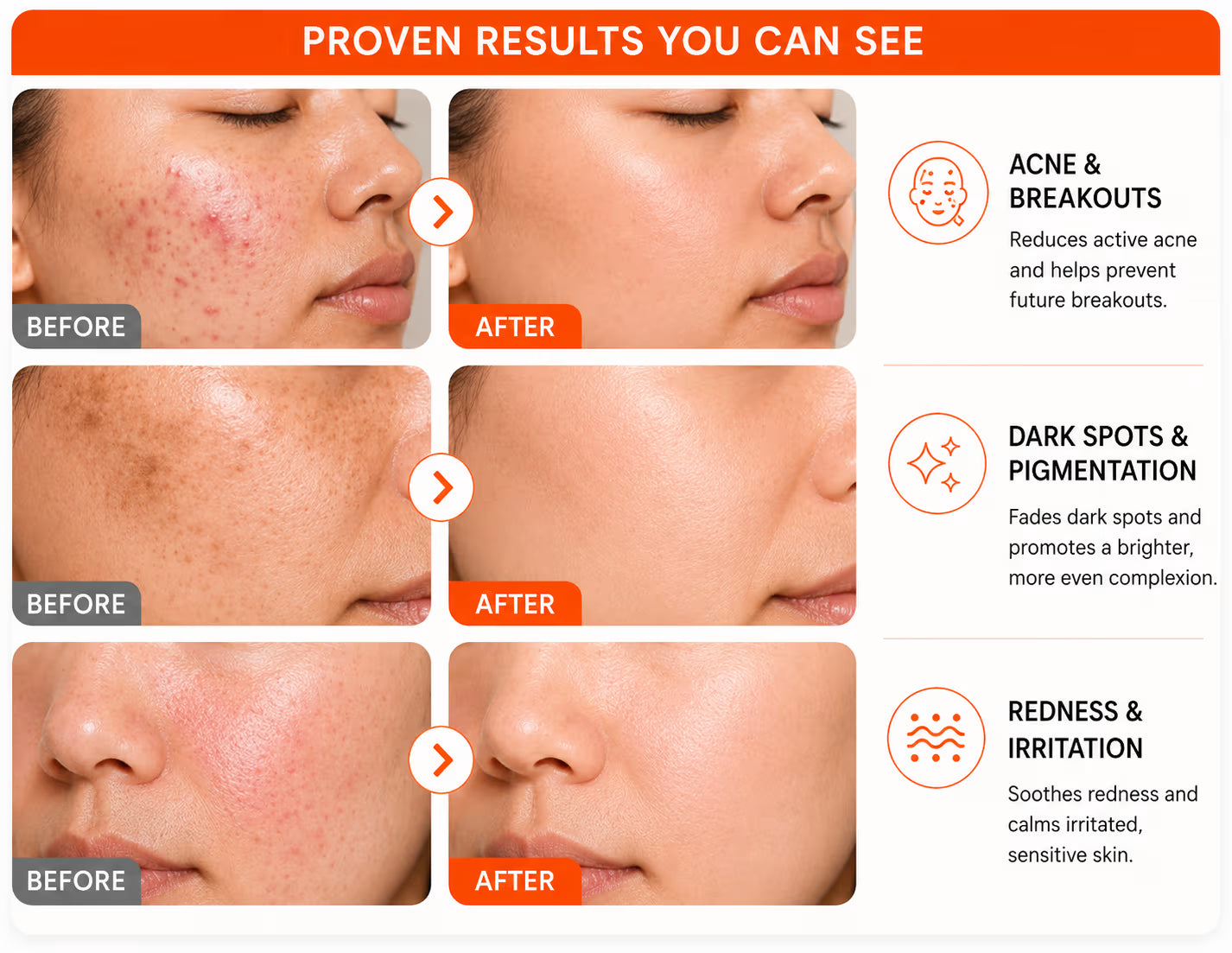 Skinoren Azelaic Acid 20% Cream