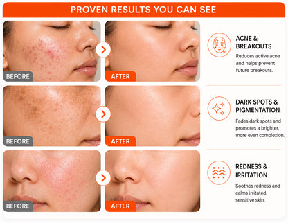 Skinoren Azelaic Acid 20% Cream